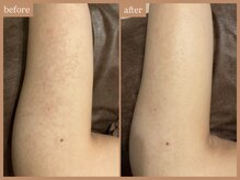 リムーン 岡崎(Re'moon)/REVI ハーブピーリング　腕