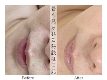 リララ(lelala)/ビフォーアフター☆