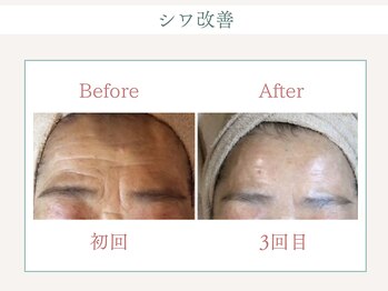 トータルビューティー ゆみえエステ(Total Beauty)/リベルハーブピーリング