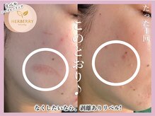 ハーバリー ハーブピーリング 大阪梅田店(HERBERRYハーブピーリング)/梅田ハーブピーリングHERBERRY