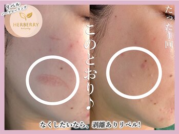 ハーバリー ハーブピーリング 大阪梅田店(HERBERRYハーブピーリング)/梅田ハーブピーリングHERBERRY