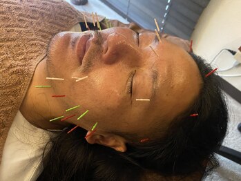 リノア鍼灸院(LINOA)/メンズ小顔鍼☆リフトアップ効果