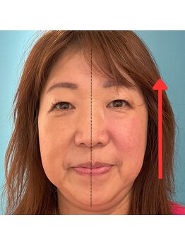 ネクスフィット(Nexfit)/小顔矯正フェイスリフトの効果