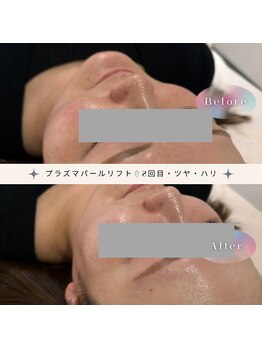 ディアー(Dear)/プラズマパールリフト