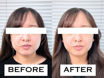 ビハリスト 吉祥寺北口/ ほうれい線が改善!