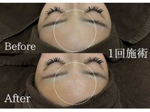 リネ(Rine)/産毛除去でツヤツヤおでこ♪