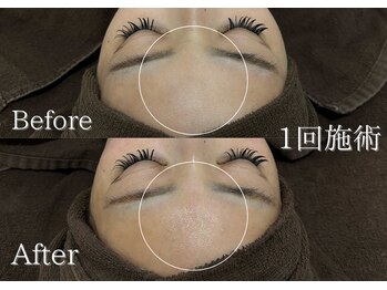 リネ(Rine)/産毛除去でツヤツヤおでこ♪