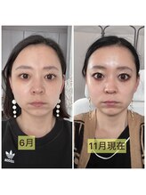 リリースパ 辻堂店(Lily spa)/【韓国肌質改善】シミシワ改善