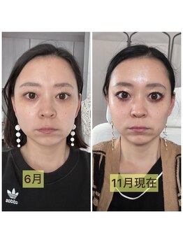 リリースパ 辻堂店(Lily spa)/【韓国肌質改善】シミシワ改善