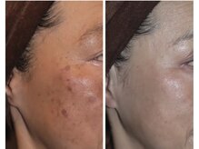 シミケア、美肌&小顔メニューも充実！なりたいお肌に導きます！