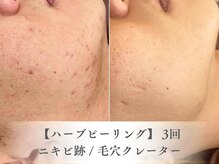 ベルペール(Belle perle)/【ハーブピーリング】毛穴/シミ