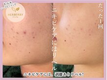 ハーバリー ハーブピーリング 大阪梅田店(HERBERRYハーブピーリング)/梅田ハーブピーリングHERBERRY