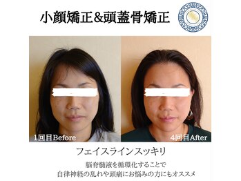 RKY/小顔矯正&頭蓋骨矯正4回(30代)