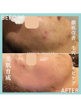 ジュネラ ボーテ(Jenela beaute)/美肌育成