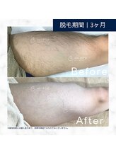 メンズクリア 武蔵小杉店/【メンズクリア】お客様の施術例
