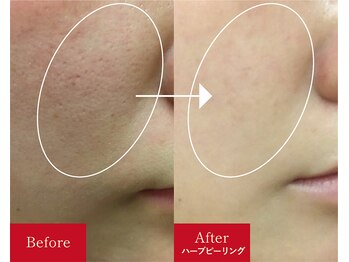 メロー(MELLOW)/ハーブピーリング(凸凹のケア)