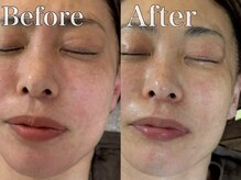 いやしの家さくら/水素フェイシャルビフォーアフタ