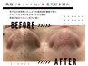 毛穴ごっそり洗浄！角栓バキュームPro×レチノール毛穴引き締め ¥8800→¥6600