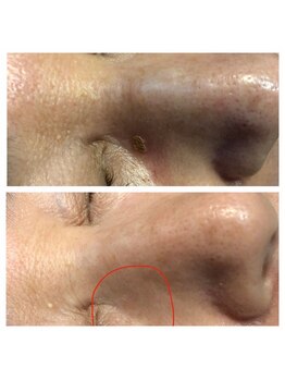 サロンドベル(salon de Belle)/プラズマ/毛穴/透明感/くすみ