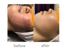 ペネロープ 緑井店(penelope)の雰囲気(人気NO,1【ニキビケア】20代女性)