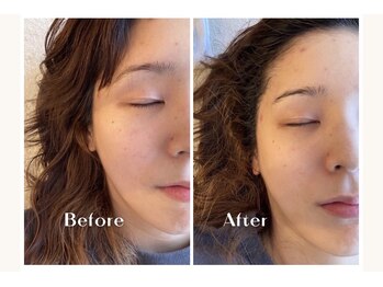 キラリ(Kirari)/【美肌エステ1回の施術】