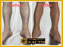 ゴールドプラス 新倉敷店(GOLD PLUS)/脚WAX脱毛ビフォーアフター