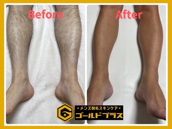 ゴールドプラス 新倉敷店(GOLD PLUS)/脚WAX脱毛ビフォーアフター