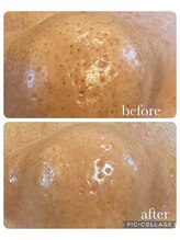 オゾンレメディ(O3remedy)/毛穴エクストラクション