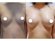 エミュボディ 青山本店(emu body)/バストアップ写真　乳房リリース