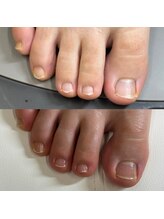 リリ(lili)/フットネイルスキンケア1回目