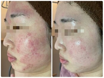 オリーブ コクブンジ(Olive kokubunji)/ハーブピーリング｜赤らみ・美白