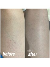 セルフメイド 石巻店/【ビフォーアフター】セルフ脱毛