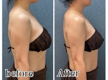 ビーホープ(B.hope)/40代モニター様2回目の変化