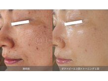 マルレ 三軒茶屋(MARLE)/4回目でシワの改善