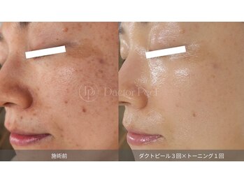 マルレ 三軒茶屋(MARLE)/4回目でシワの改善