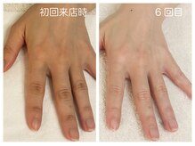 キレイテ 福岡天神店/40代/6回目【博多ハンドケア】