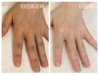 キレイテ 福岡天神店/40代/6回目【博多ハンドケア】