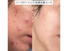 ソアン(Soin)/肌質改善コース