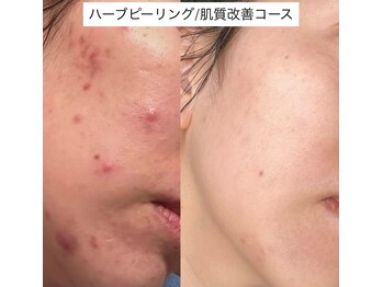 ソアン(Soin)/肌質改善コース
