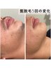 【men's】再来クーポン！時間もお金も掛けないヒゲ脱毛☆契約無し！￥4,500