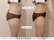 ピーチハート(Peach Heart)/ハイパー痩身ビフォーアフター