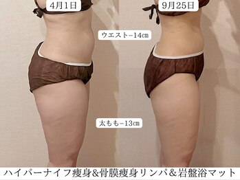 ピーチハート(Peach Heart)/ハイパー痩身ビフォーアフター