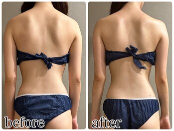 メロウ(me: llow)/ハイパーナイフEX/痩身エステ