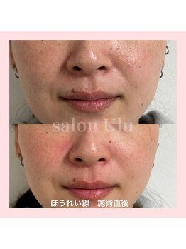ウル(Ulu)/ほうれい線改善