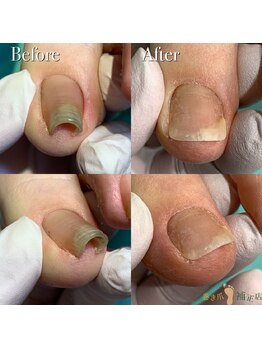 巻き爪補正店 那覇店/