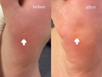 爪のいろは/痛っ！小さな魚の目も丁寧ケア♪