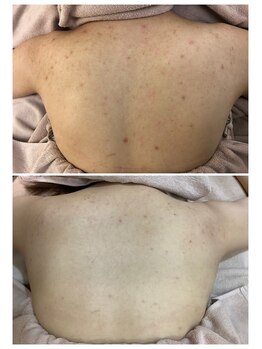 エスティ 京都店/背中トリートメント