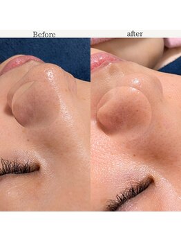 エミナル バイ ニコドット(Eminal by nico.)/毛穴の詰まり・1回目のケア後