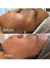 ブルームーン(Blue Moon)/リベルハーブピーリング　2回