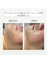 ノドカ 新市街店(NODOKA)/赤みを落ち着かせツヤ肌に